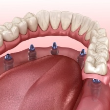 Animated dental implant supported dentures placement