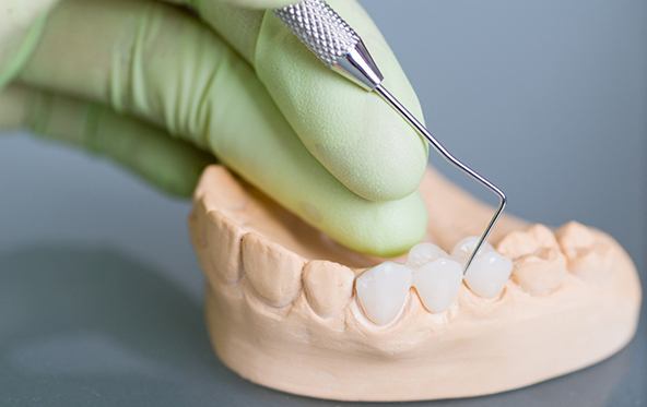 Gloved hand poking sample dental bridge on model jaw