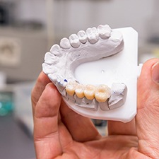 Hand holding up cast of lower jaw with dental bridge