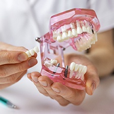 Hands holding sample jaw with implants and dental bridge