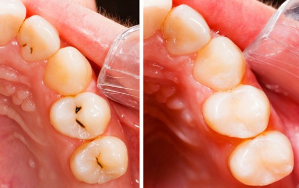 : a before-and-after photo of treated cavities