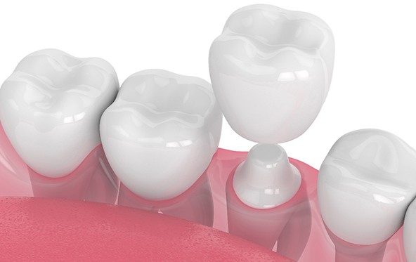 3D render of teeth and dental crown in Fuquay-Varina, NC