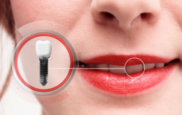 Closeup of smile with animated dental implant