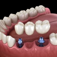 Animated dental implant supported supported fixed bridge placement