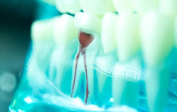 a dental model that shows the inner chamber of a tooth