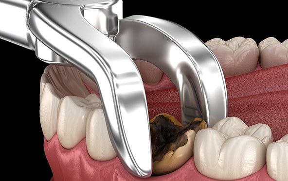a digital illustration showing a severely damaged tooth being extracted