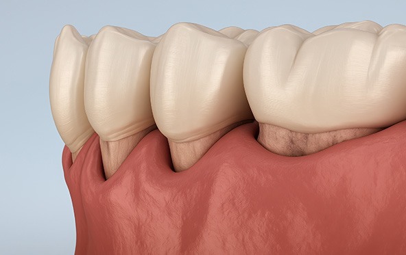 Digital view of gum recession