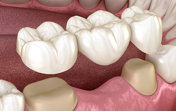 Animated smiling during dental bridge tooth replacement treatment