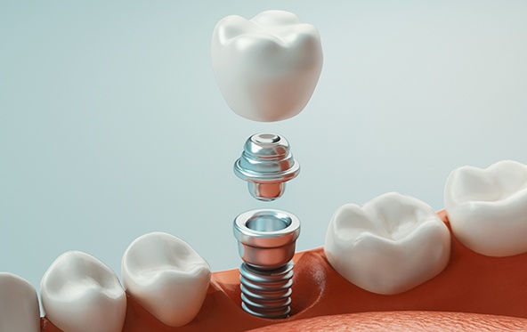 Animated smile during dental implant tooth replacement