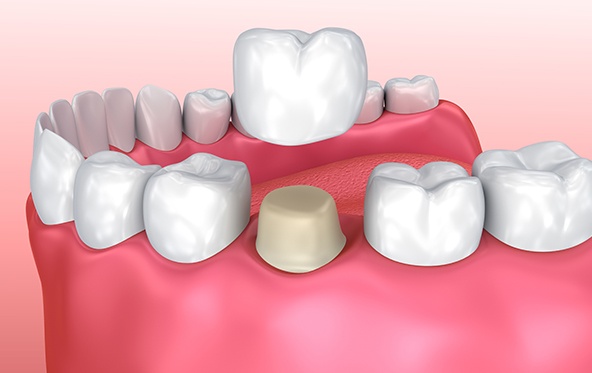 Animated smile during dental crown restorative dentistry treatment