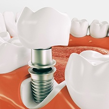Parts of a single dental implant