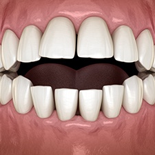 Illustration of an open bite