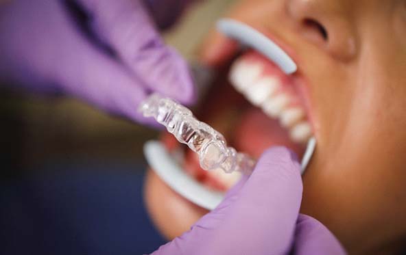 Dentist placing Invisalign in Fuquay-Varina in patient's mouth