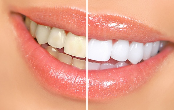 teeth whitening in Fuquay-Varina before and after